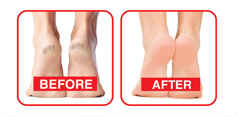 Preventing and Treating Cracked Heels — Podiatry Group of Annapolis, P.A.